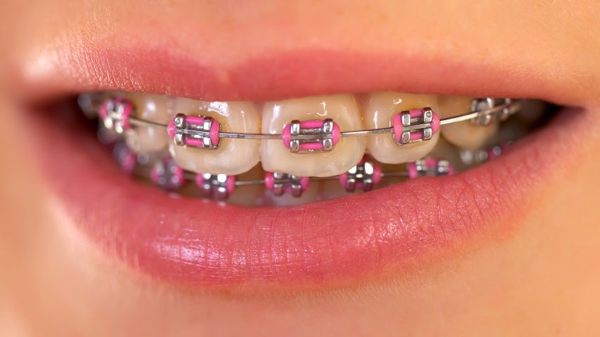 Uśmiechnięte usta ukazujące aparat ortodontyczny z różowymi zamkami.