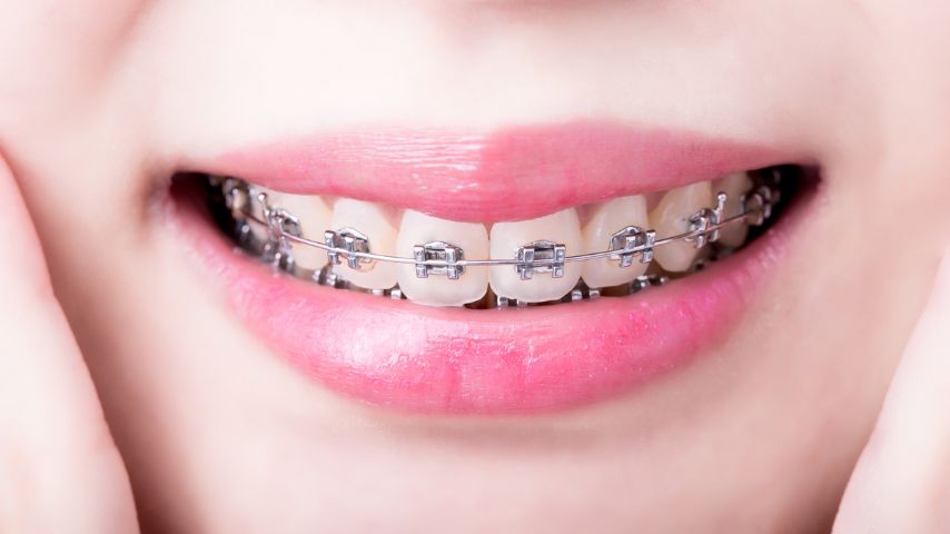 Zbliżenie na łagodny uśmiech kobiety ukazujący aparat ortodontyczny na zębach.
