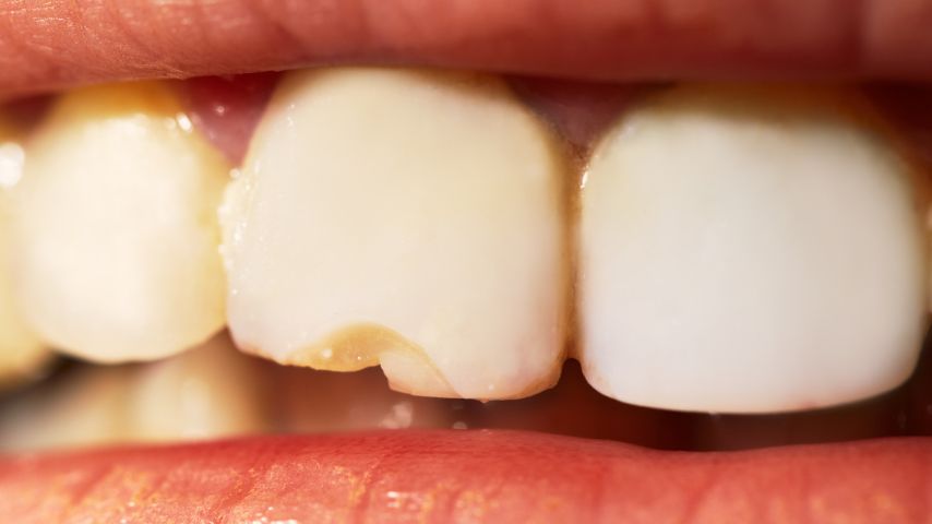 Zbliżenie otwarte usta i niewielki uszczerbek zęba siekacza
