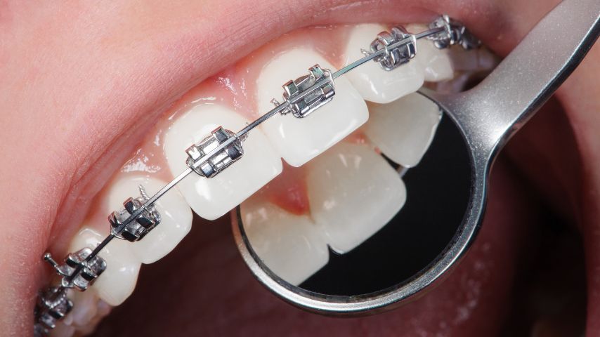 Lusterko dentystyczne w jamie ustnej osoby noszącej aparat ortodontyczny.