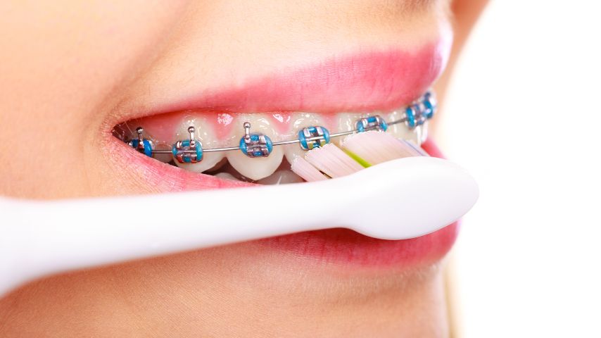 Zbliżenie na otwarte usta kobiety noszącej aparat ortodontyczny z przyłożoną szczoteczką do mycia.