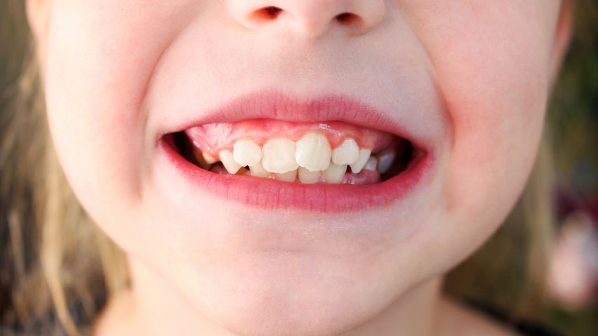 Zbliżenie na nierówno rozstawione zęby w buzi dziecka.